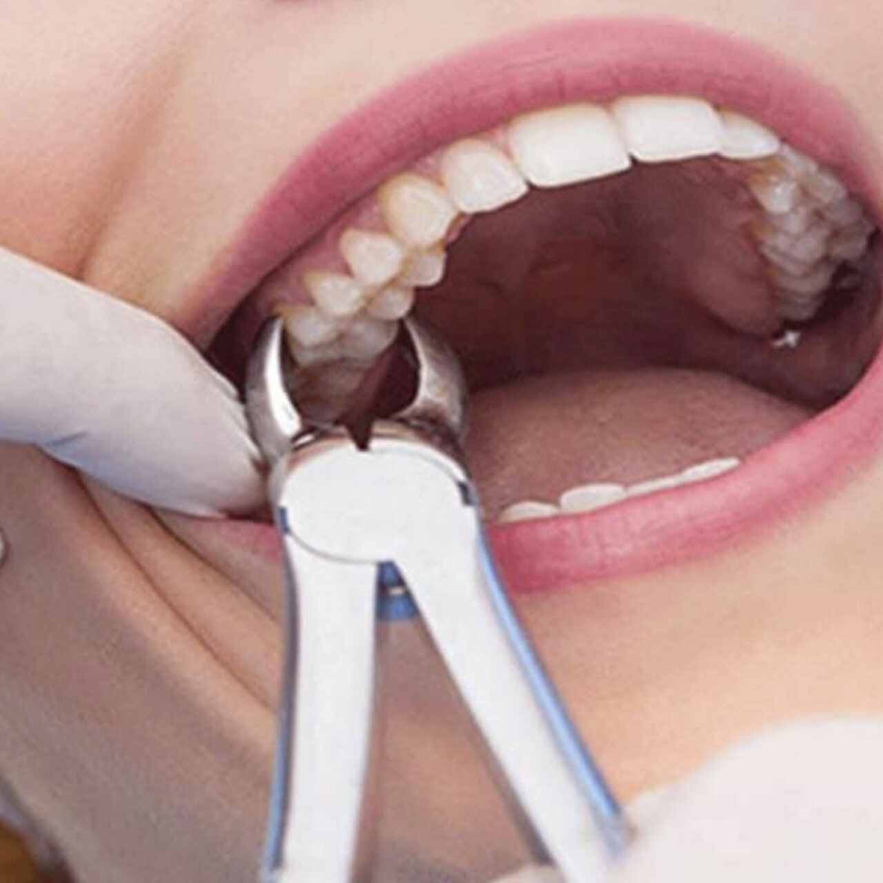 https://frigyadental.com/wp-content/uploads/2023/03/discekimi-1280x1280.jpg